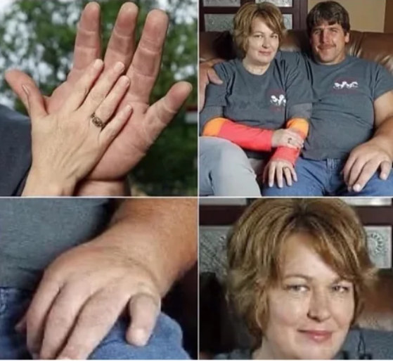 woman with a cast on her hand and a man with a cast on his hand